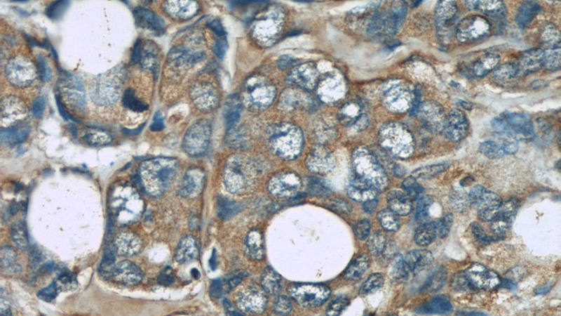 Immunohistochemistry of paraffin-embedded human breast cancer slide using Catalog No:107646(TRPC4AP Antibody) at dilution of 1:50