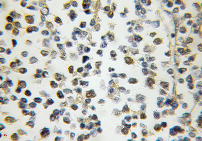 Immunohistochemical of paraffin-embedded human lymphoma using Catalog No:113219(NPM3 antibody) at dilution of 1:50 (under 10x lens)