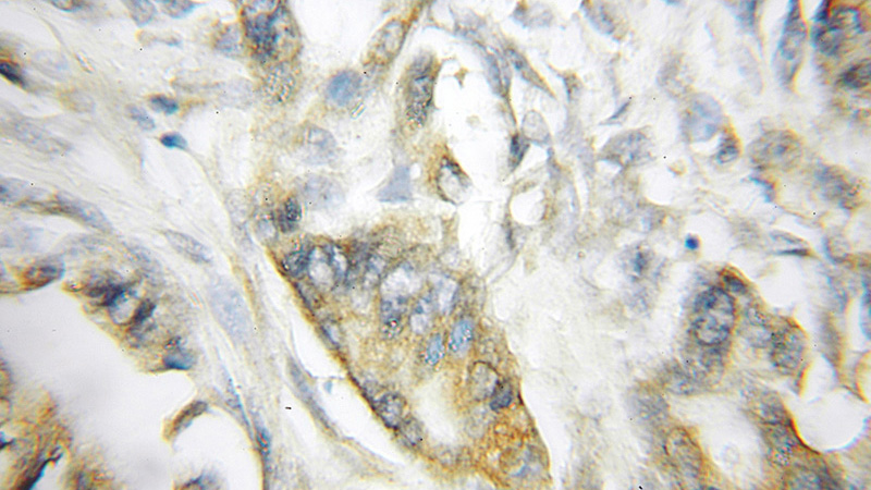Immunohistochemical of paraffin-embedded human pancreas cancer using Catalog No:114997(SCIN antibody) at dilution of 1:50 (under 10x lens)