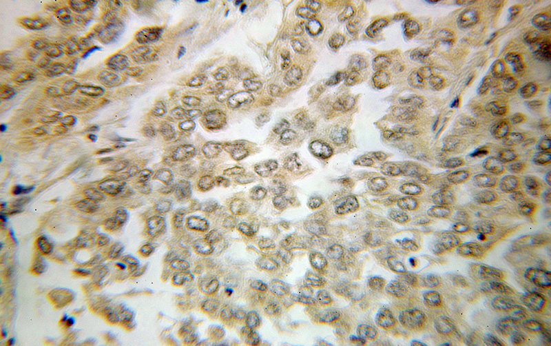 Immunohistochemical of paraffin-embedded human lung cancer using Catalog No:116774(VPS18 antibody) at dilution of 1:100 (under 10x lens)