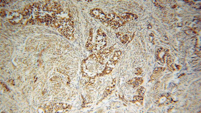Immunohistochemical of paraffin-embedded human endometrial cancer using Catalog No:107761(ADAM12 antibody) at dilution of 1:100 (under 10x lens)