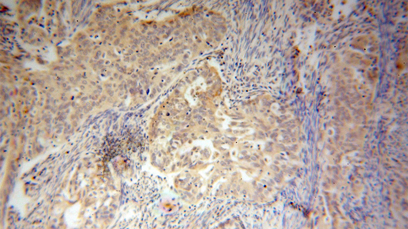 Immunohistochemical of paraffin-embedded human endometrial cancer using Catalog No:110233(ELP4 antibody) at dilution of 1:50 (under 10x lens)