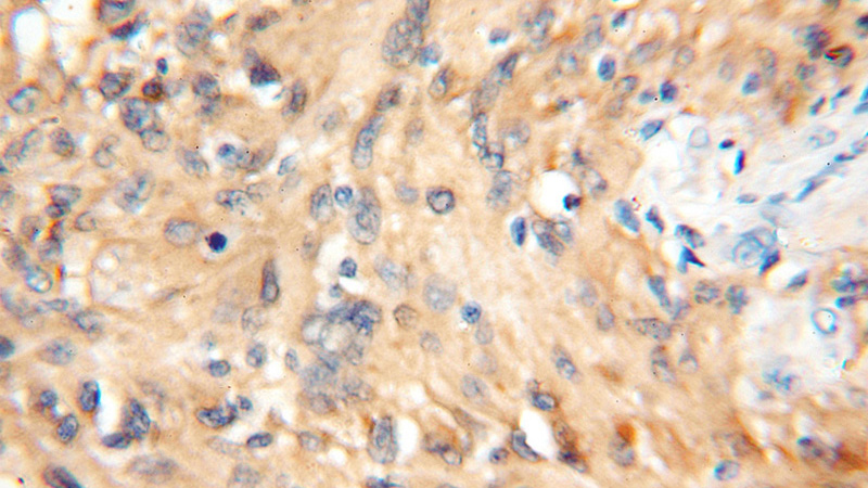 Immunohistochemical of paraffin-embedded human gliomas using Catalog No:107659(14-3-3E antibody) at dilution of 1:100 (under 10x lens)