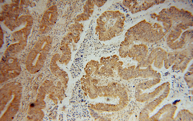 Immunohistochemical of paraffin-embedded human colon cancer using Catalog No:109432(CNOT10 antibody) at dilution of 1:50 (under 10x lens)