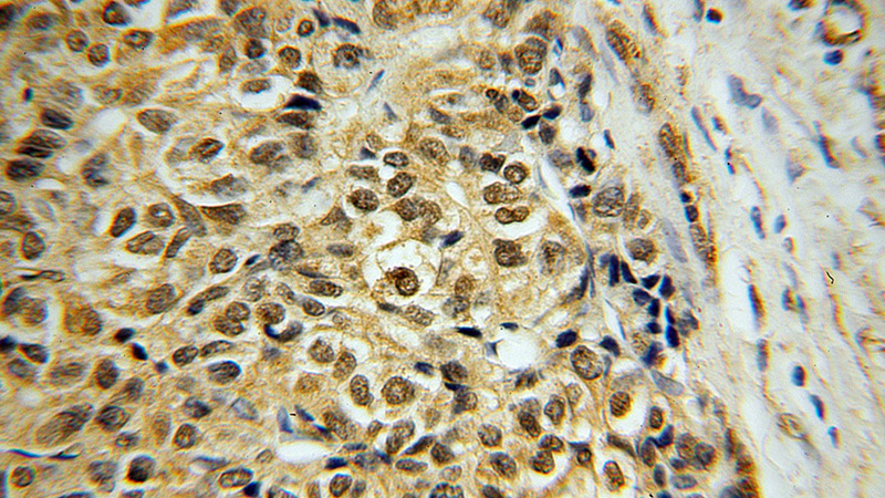 Immunohistochemical of paraffin-embedded human liver cancer using Catalog No:114468(RARB antibody) at dilution of 1:50 (under 40x lens)