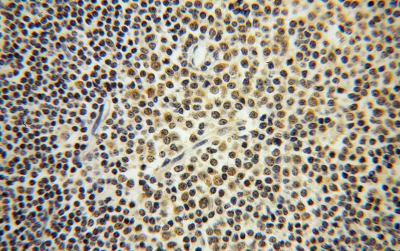 Immunohistochemical of paraffin-embedded human lymphoma using Catalog No:114781(ROD1 antibody) at dilution of 1:100 (under 40x lens)