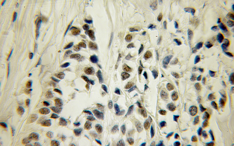 Immunohistochemical of paraffin-embedded human breast cancer using Catalog No:109739(CUGBP1 antibody) at dilution of 1:100 (under 10x lens)