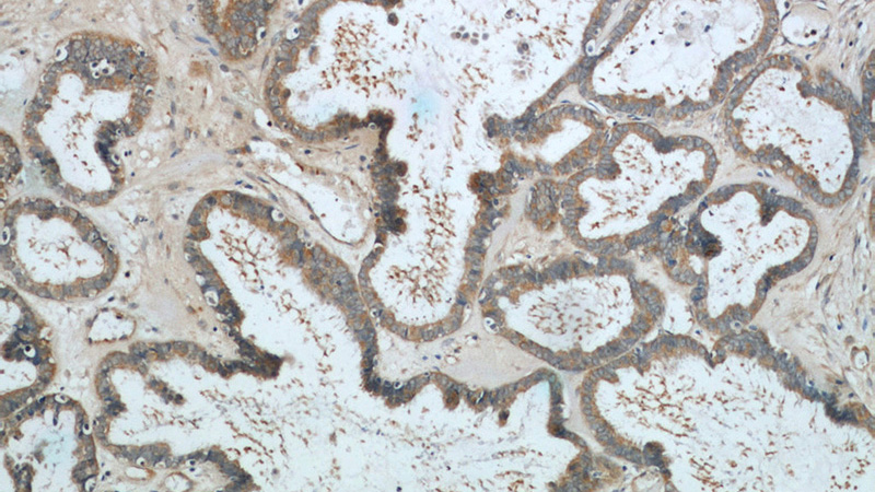 Immunohistochemistry of paraffin-embedded human ovary tumor tissue slide using Catalog No:113664(PDE5A Antibody) at dilution of 1:200 (under 10x lens).