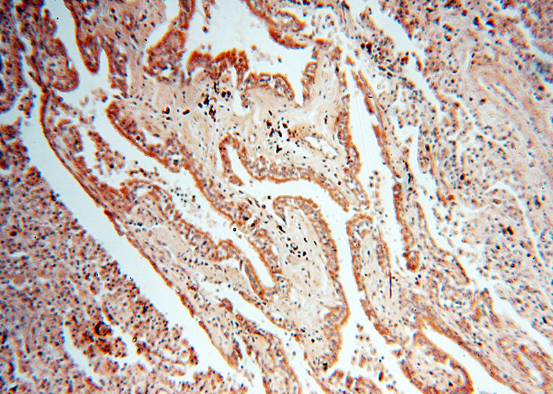 Immunohistochemical of paraffin-embedded human lung cancer using Catalog No:112382(MAGEA6 antibody) at dilution of 1:50 (under 10x lens)