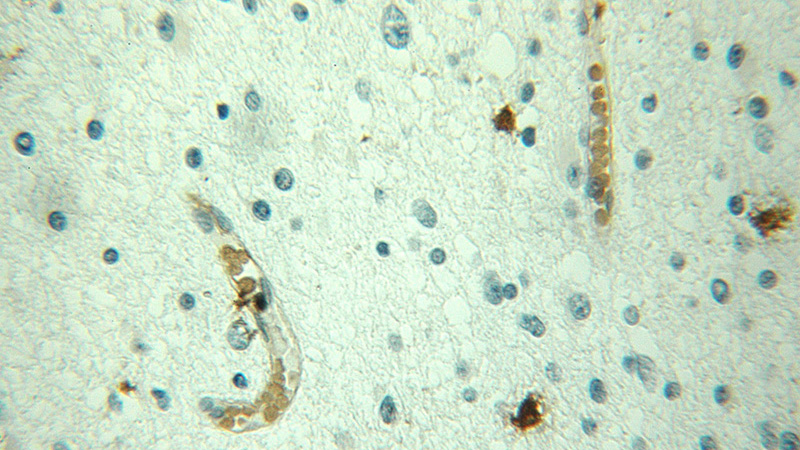 Immunohistochemical of paraffin-embedded human gliomas using Catalog No:111900(JUNB antibody) at dilution of 1:50 (under 25x lens)