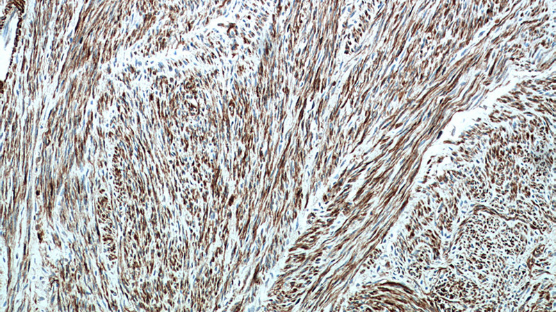 Immunohistochemical of paraffin-embedded human hysteromyoma using Catalog No:107705(ACTA2 antibody) at dilution of 1:50 (under 10x lens)