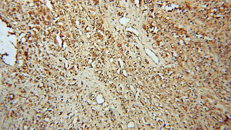 Immunohistochemical of paraffin-embedded human prostate cancer using Catalog No:111547(HSD17B4 antibody) at dilution of 1:100 (under 10x lens)