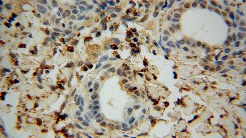 Immunohistochemical of paraffin-embedded human cervical cancer using Catalog No:110362(ERK1/2 antibody) at dilution of 1:100 (under 40x lens)