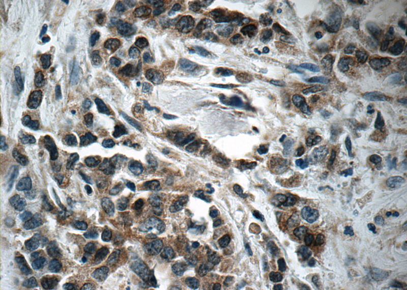 Immunohistochemistry of paraffin-embedded human stomach cancer tissue slide using Catalog No:113708(PGA5 Antibody) at dilution of 1:50 (under 40x lens)
