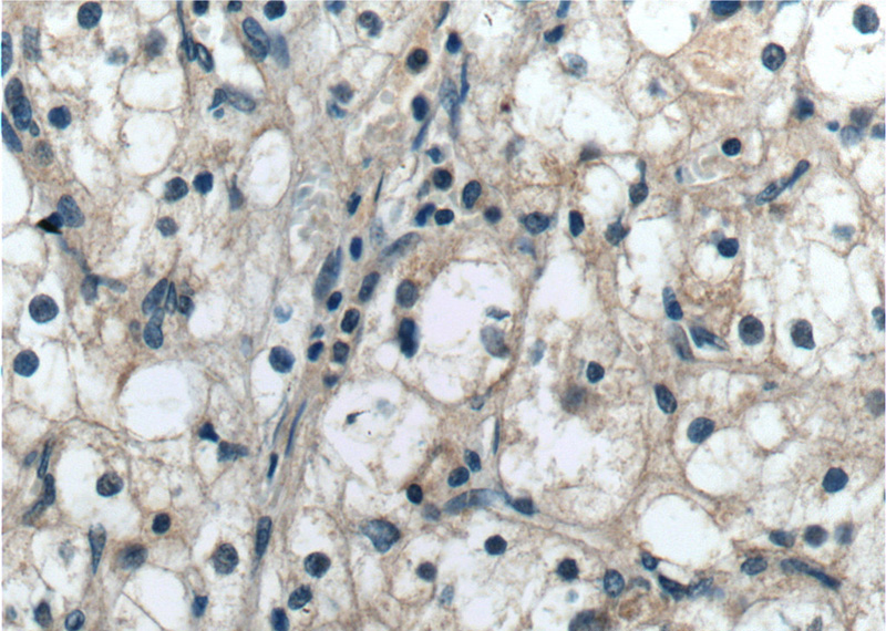 Immunohistochemistry of paraffin-embedded human renal cell carcinoma tissue slide using Catalog No:108386(BCKDHB Antibody) at dilution of 1:50 (under 40x lens)