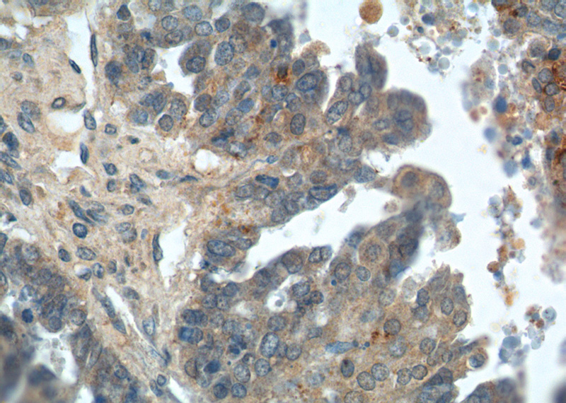 Immunohistochemistry of paraffin-embedded human ovary tumor tissue slide using Catalog No:111905(KLK8 Antibody) at dilution of 1:200 (under 40x lens).