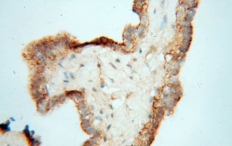 Immunohistochemical of paraffin-embedded human ovary tumor using Catalog No:116857(WDR18 antibody) at dilution of 1:100 (under 40x lens)