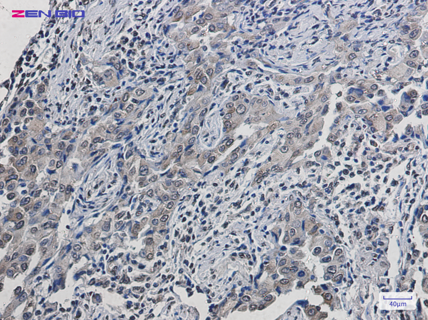 Immunohistochemistry of SCD1 in paraffin-embedded Human lung cancer tissue using SCD1 Rabbit pAb at dilution 1/50