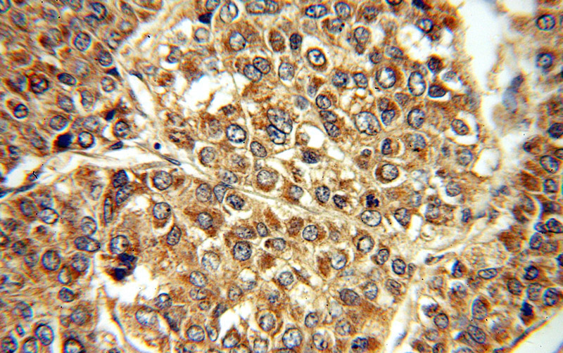 Immunohistochemical of paraffin-embedded human liver cancer using Catalog No:114427(RAB27B antibody) at dilution of 1:50 (under 40x lens)