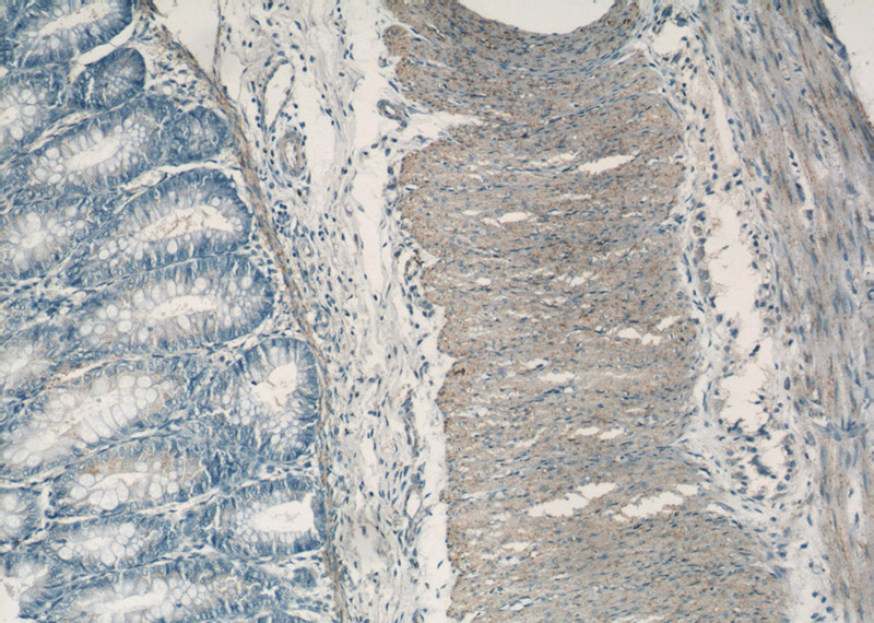 Immunohistochemistry of paraffin-embedded human colon tissue slide using Catalog No:108821(CALD1 Antibody) at dilution of 1:50 (under 10x lens)