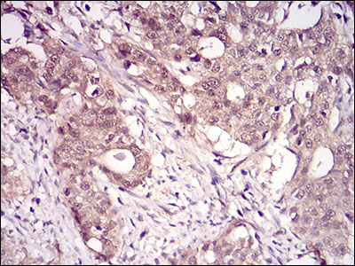 Immunohistochemical analysis of paraffin-embedded cervical cancer tissues using RANBP9 mouse mAb with DAB staining.