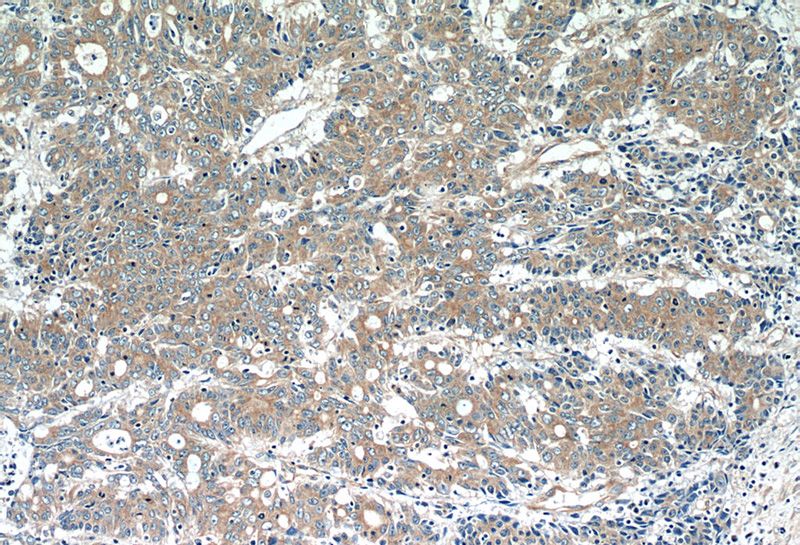 Immunohistochemistry of paraffin-embedded human colon cancer tissue slide using Catalog No:112722(MOBKL3 Antibody) at dilution of 1:50 (under 10x lens)