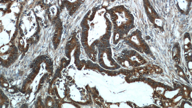 Immunohistochemical of paraffin-embedded human colon cancer using Catalog No:111279(HCFC1 antibody) at dilution of 1:50 (under 10x lens)
