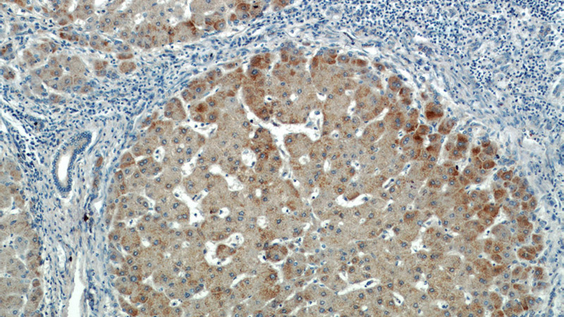 Immunohistochemical of paraffin-embedded human hepatocirrhosis using Catalog No:111275(HBXIP antibody) at dilution of 1:50 (under 10x lens)