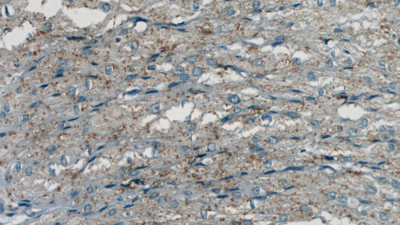 Immunohistochemistry of paraffin-embedded human colon tissue slide using Catalog No:108821(CALD1 Antibody) at dilution of 1:50 (under 40x lens)