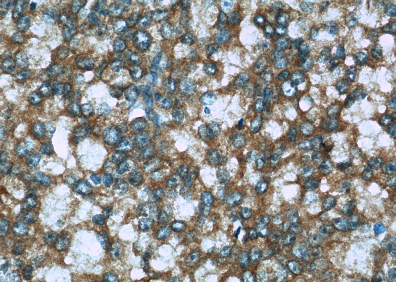 Immunohistochemistry of paraffin-embedded human prostate cancer slide using Catalog No:116407(TRPC4AP Antibody) at dilution of 1:50