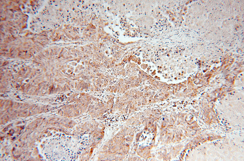 Immunohistochemical of paraffin-embedded human lung cancer using Catalog No:110119(DUSP22 antibody) at dilution of 1:50 (under 10x lens)