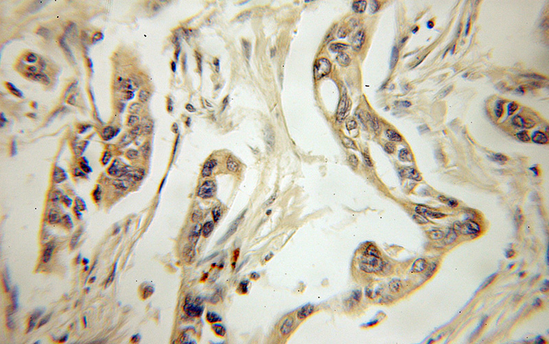 Immunohistochemical of paraffin-embedded human pancreas cancer using Catalog No:111895(JP45; JSRP1 antibody) at dilution of 1:50 (under 10x lens)