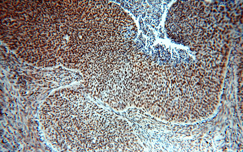 Immunohistochemical of paraffin-embedded human cervical cancer using Catalog No:115110(SENP5-Specific antibody) at dilution of 1:100 (under 10x lens)