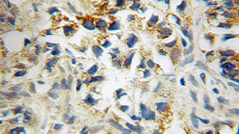 Immunohistochemical of paraffin-embedded human gliomas using Catalog No:115730(STOML1 antibody) at dilution of 1:100 (under 10x lens)
