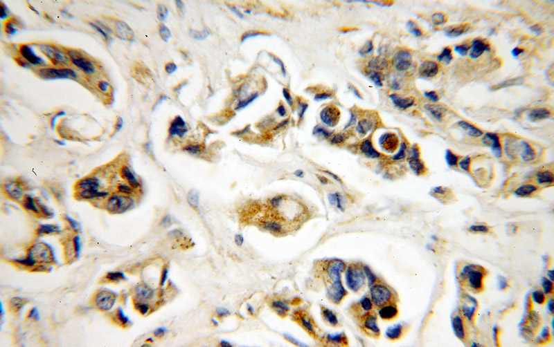 Immunohistochemical of paraffin-embedded human breast cancer using Catalog No:112960(NAT1 antibody) at dilution of 1:50 (under 40x lens)