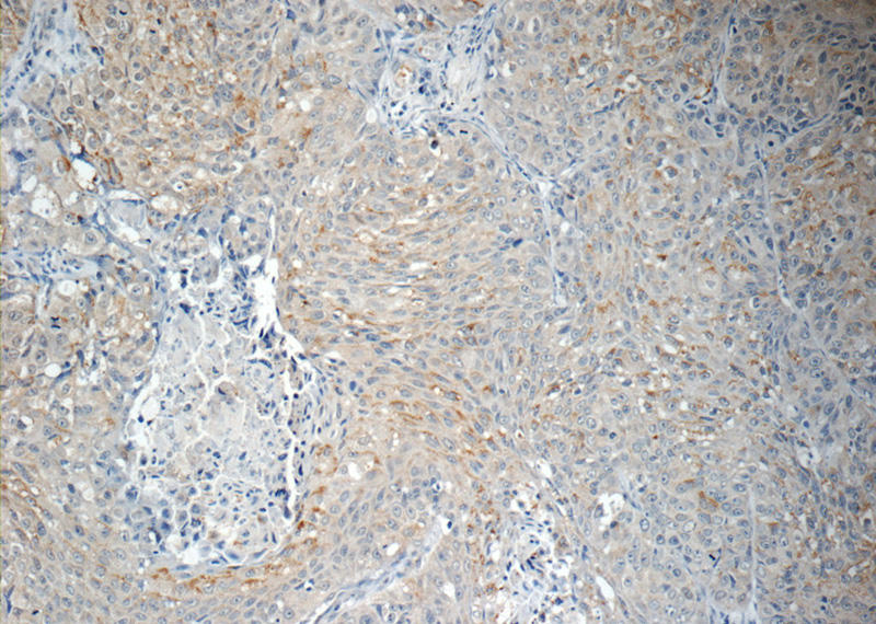 Immunohistochemistry of paraffin-embedded human lung cancer tissue slide using Catalog No:107916(AGBL3 Antibody) at dilution of 1:50 (under 10x lens)