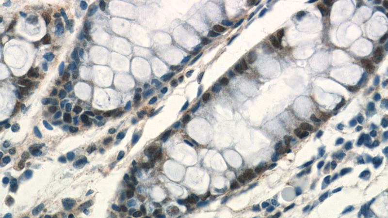 Immunohistochemistry of paraffin-embedded human colon tissue slide using Catalog No:112869(MSH6 Antibody) at dilution of 1:200 (under 40x lens)