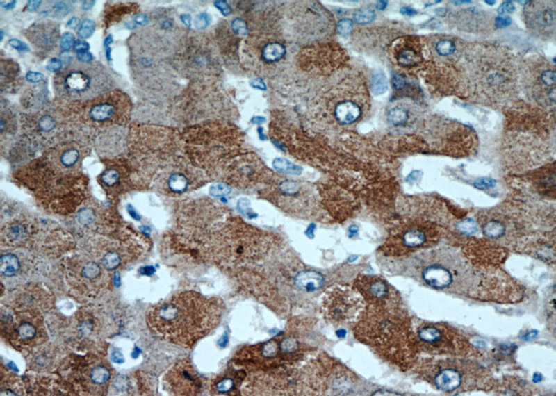 Immunohistochemical of paraffin-embedded human hepatocirrhosis using Catalog No:107975(ALDH8A1 antibody) at dilution of 1:50 (under 40x lens)