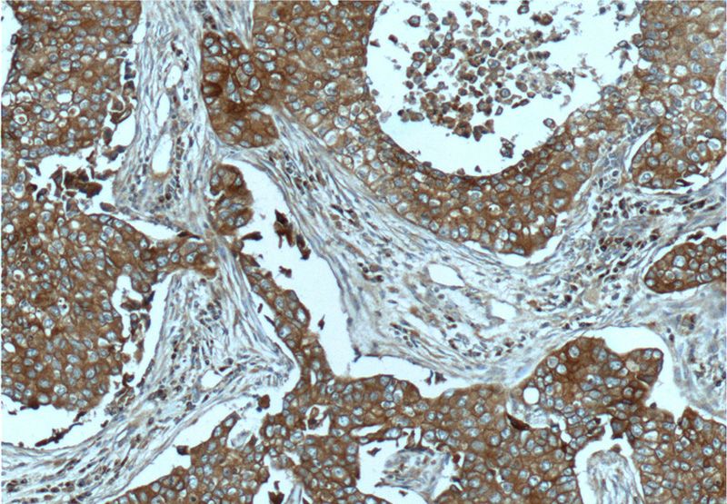 Immunohistochemistry of paraffin-embedded human breast cancer tissue slide using Catalog No:112513(MET Antibody) at dilution of 1:50 (under 10x lens)