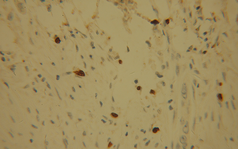 Immunohistochemical of paraffin-embedded human pancreas cancer using Catalog No:114003(POLI antibody) at dilution of 1:100 (under 40x lens)