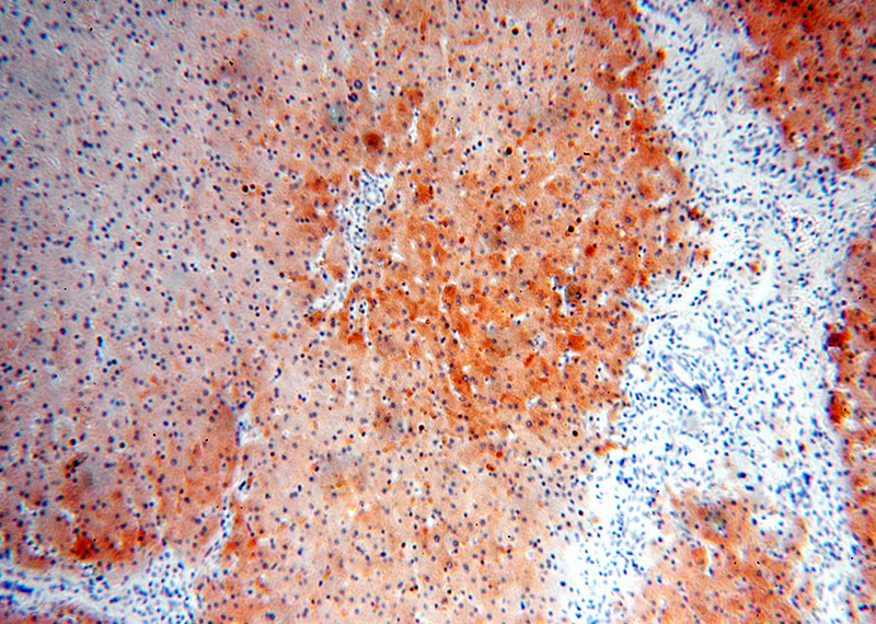 Immunohistochemical of paraffin-embedded human liver using Catalog No:107977(ALDOB antibody) at dilution of 1:100 (under 10x lens)