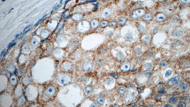 Immunohistochemistry of paraffin-embedded human breast cancer tissue slide using Catalog No:112495(MATK Antibody) at dilution of 1:50 (under 40x lens)