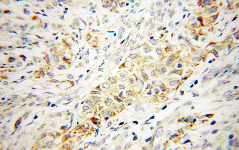 Immunohistochemical of paraffin-embedded human endometrial cancer using Catalog No:109722(CTDSPL2 antibody) at dilution of 1:100 (under 40x lens)