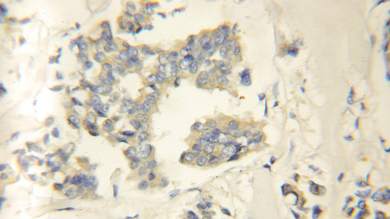 Immunohistochemical of paraffin-embedded human breast cancer using Catalog No:114757(RNF34 antibody) at dilution of 1:50 (under 10x lens)