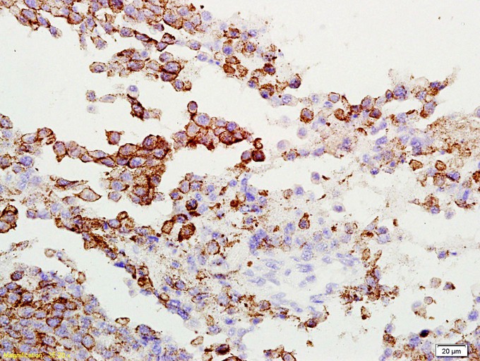 Fig2: Tissue/cell: rat lung carcinoma; 4% Paraformaldehyde-fixed and paraffin-embedded;; Antigen retrieval: citrate buffer ( 0.01M, pH 6.0 ), Boiling bathing for 15min; Block endogenous peroxidase by 3% Hydrogen peroxide for 30min; Blocking buffer (normal goat serum,C-0005) at 37℃ for 20 min;; Incubation: Anti-Gamma-Adaptin Polyclonal Antibody, Unconjugated 1:200, overnight at 4℃, followed by conjugation to the secondary antibody(SP-0023) and DAB(C-0010) staining