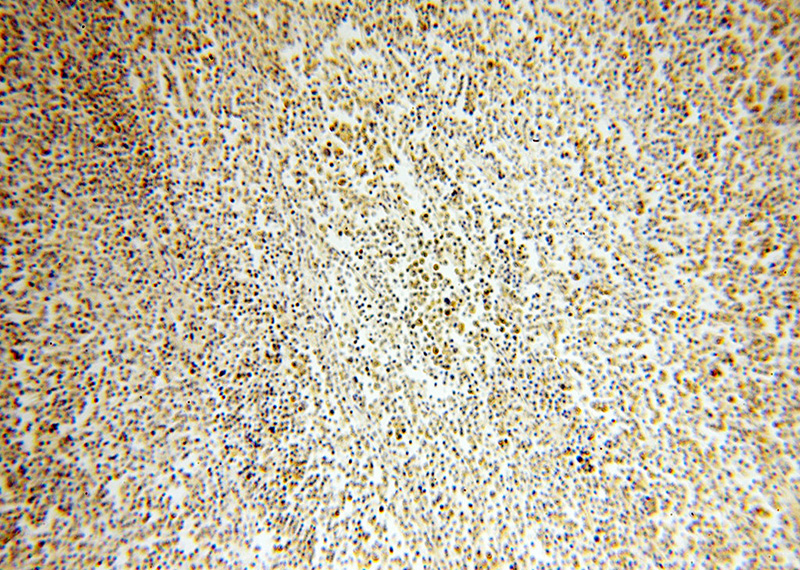 Immunohistochemical of paraffin-embedded human lymphoma using Catalog No:113285(WHSC1L1 antibody) at dilution of 1:50 (under 10x lens)