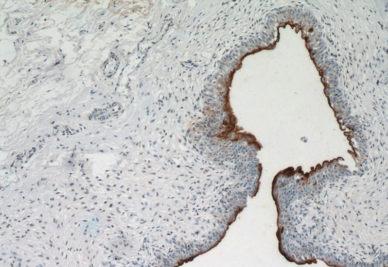 Immunohistochemistry of paraffin-embedded human bladder tissue slide using Catalog No:116628(UPK1A Antibody) at dilution of 1:1600 (under 10x lens)