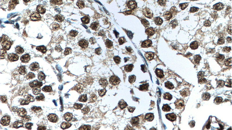 Immunohistochemistry of paraffin-embedded human prostate cancer tissue slide using Catalog No:108048(AR Antibody) at dilution of 1:200 (under 40x lens). heat mediated antigen retrieved with Tris-EDTA buffer(pH9).