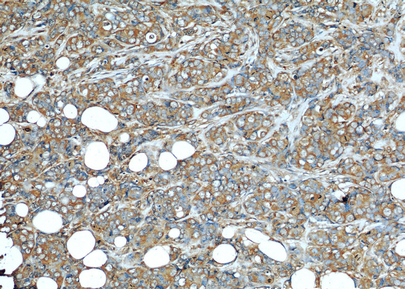 Immunohistochemistry of paraffin-embedded human breast cancer slide using Catalog No:107210(FHIT Antibody) at dilution of 1:50