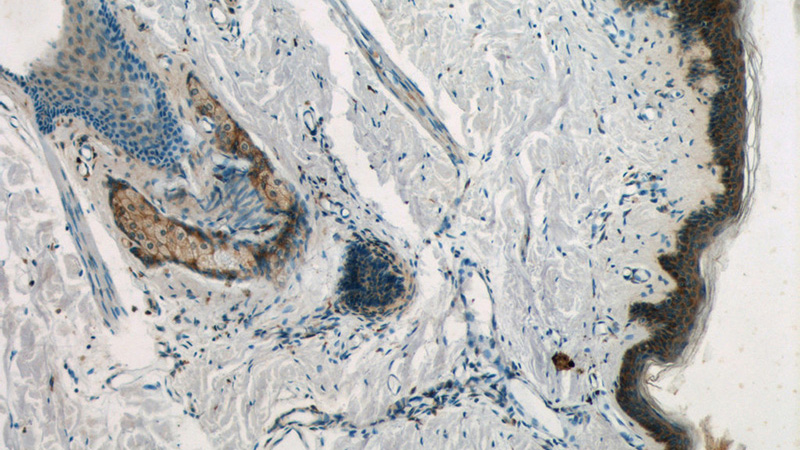 Immunohistochemistry of paraffin-embedded human skin tissue slide using Catalog No:113788(PGLYRP4 Antibody) at dilution of 1:50 (under 10x lens)